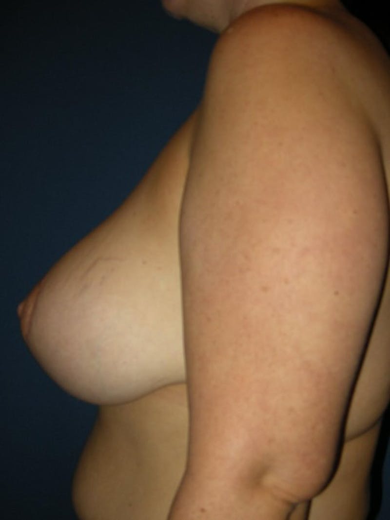 Breast Lift by Dr. Haydon Before & After Gallery - Patient 55455184 - Image 4