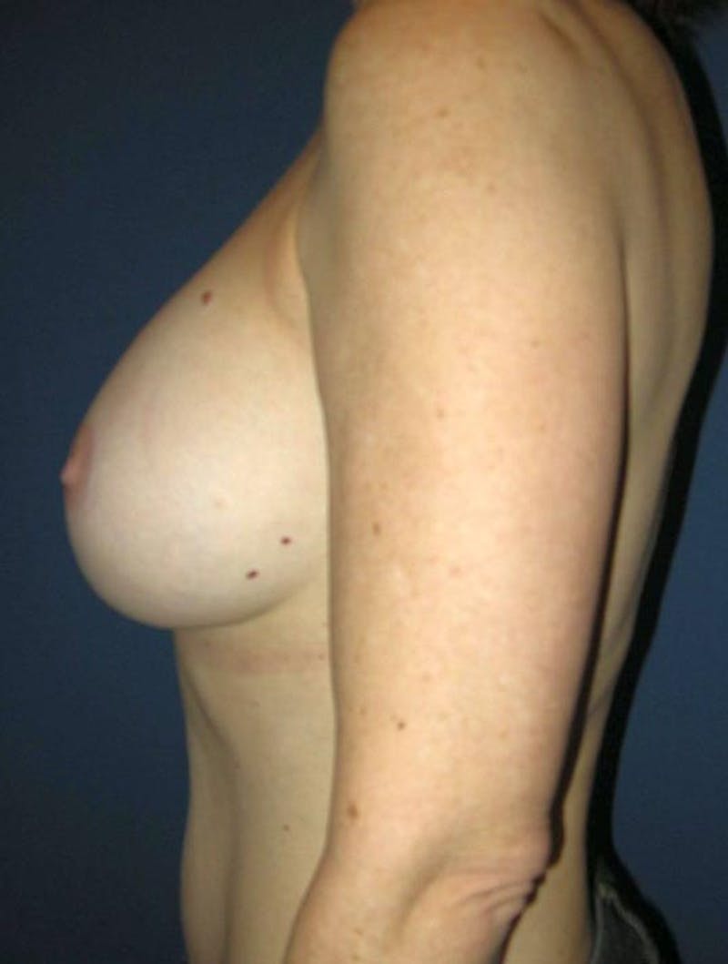 Breast Augmentation by Dr. Haydon Before & After Gallery - Patient 55455185 - Image 6