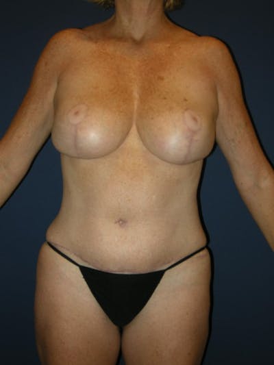 Breast Reduction by Dr. Haydon Before & After Gallery - Patient 55455187 - Image 2