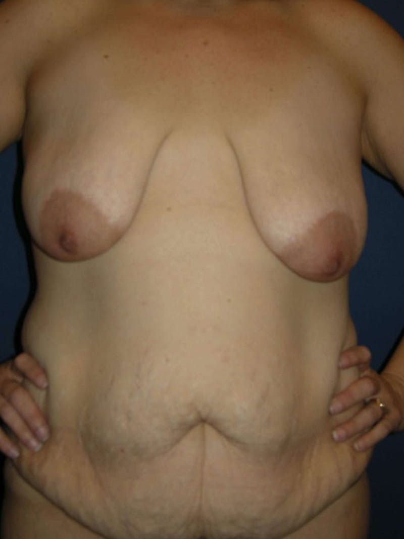 Breast Reduction by Dr. Haydon Before & After Gallery - Patient 55455192 - Image 1