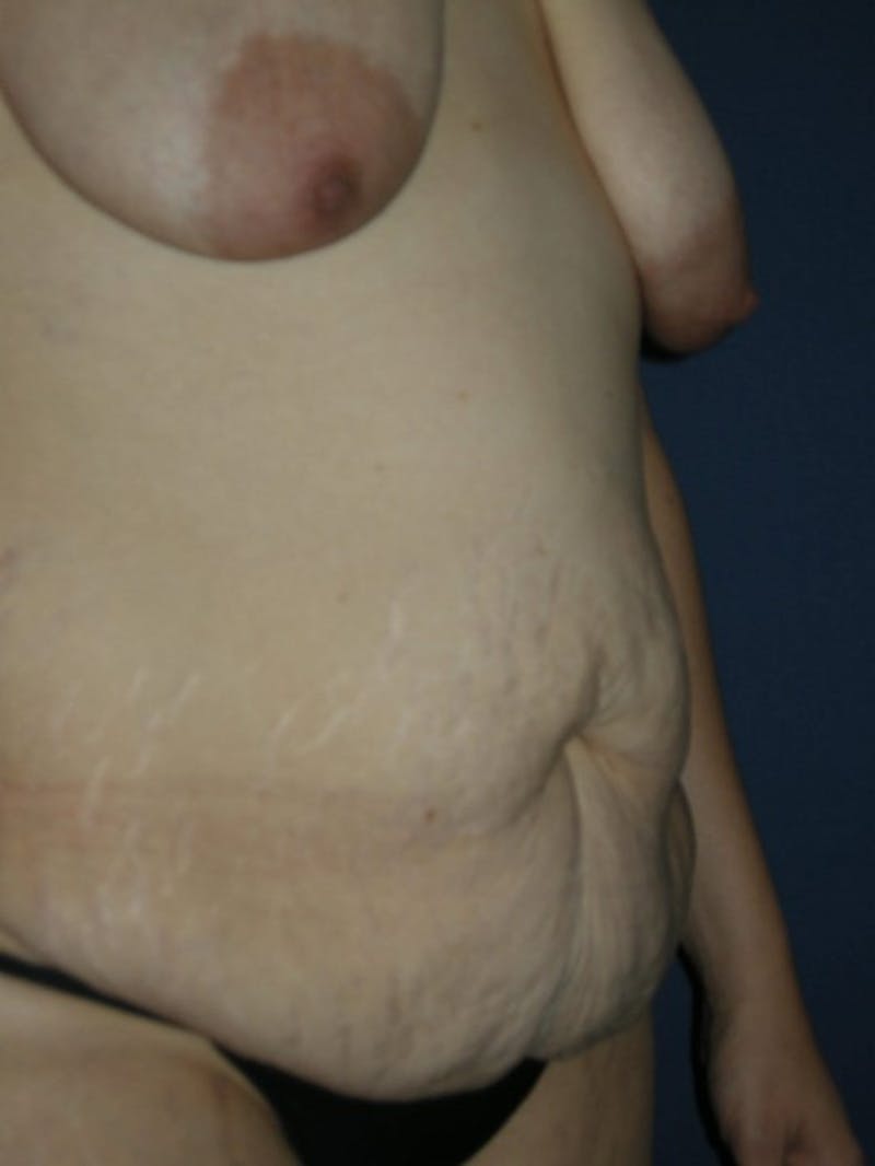 Breast Reduction by Dr. Haydon Before & After Gallery - Patient 55455192 - Image 3