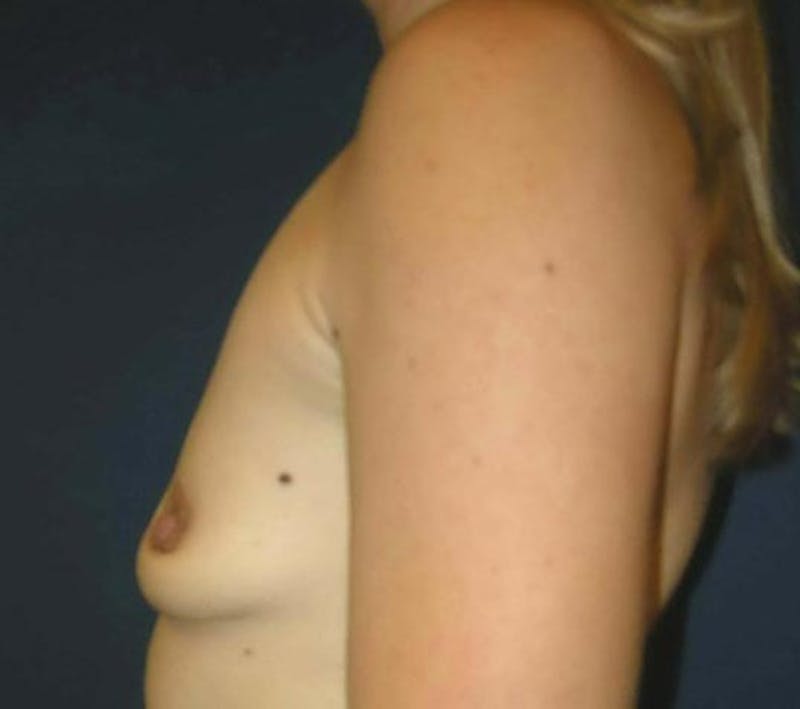 Breast Augmentation by Dr. Haydon Before & After Gallery - Patient 55455191 - Image 3