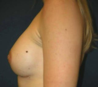 Breast Augmentation by Dr. Haydon Before & After Gallery - Patient 55455191 - Image 4