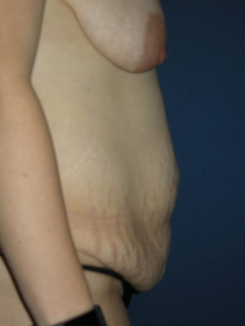 Breast Reduction by Dr. Haydon Before & After Gallery - Patient 55455192 - Image 5
