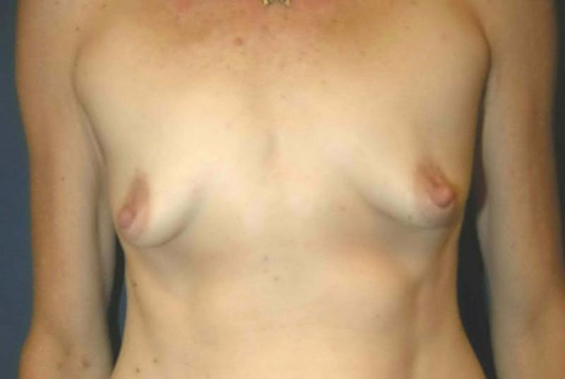 Breast Augmentation by Dr. Haydon Before & After Gallery - Patient 55455193 - Image 1