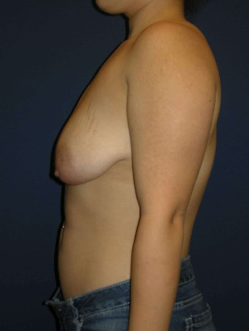 Breast Augmentation with Lift by Dr. Haydon Before & After Gallery - Patient 55455194 - Image 5