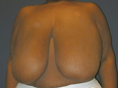 Breast Reduction by Dr. Haydon Gallery - Patient 55455198 - Image 1
