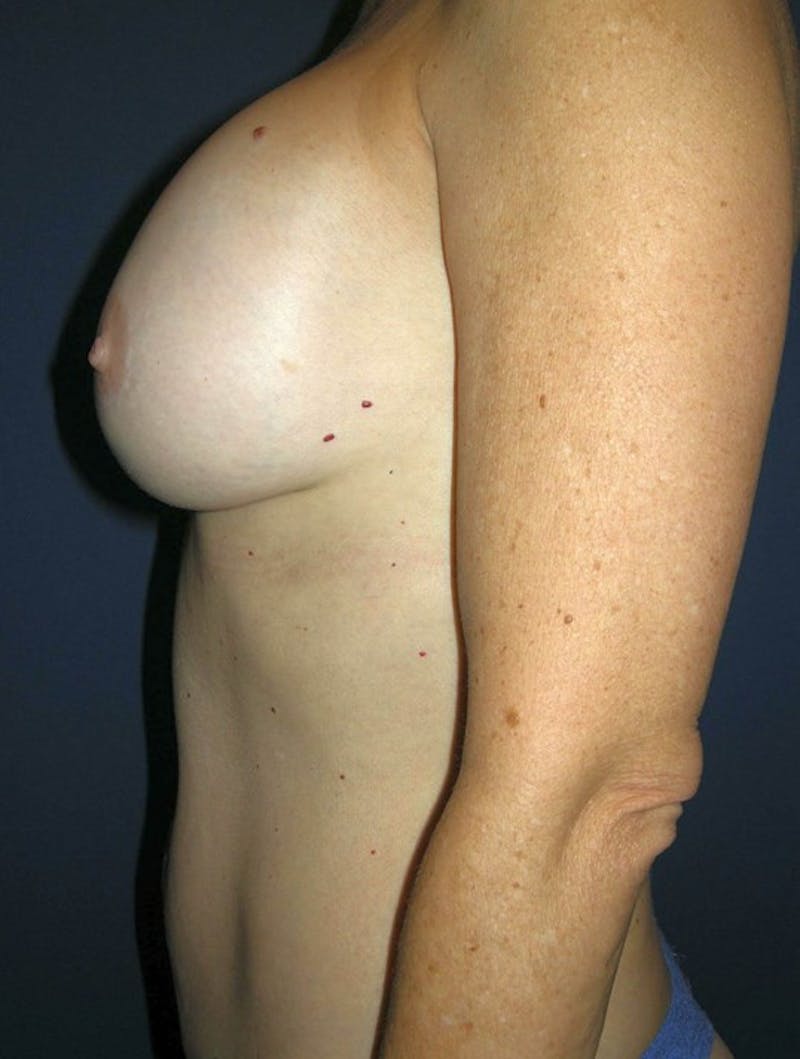 Breast Revision by Dr. Haydon Before & After Gallery - Patient 55455196 - Image 5