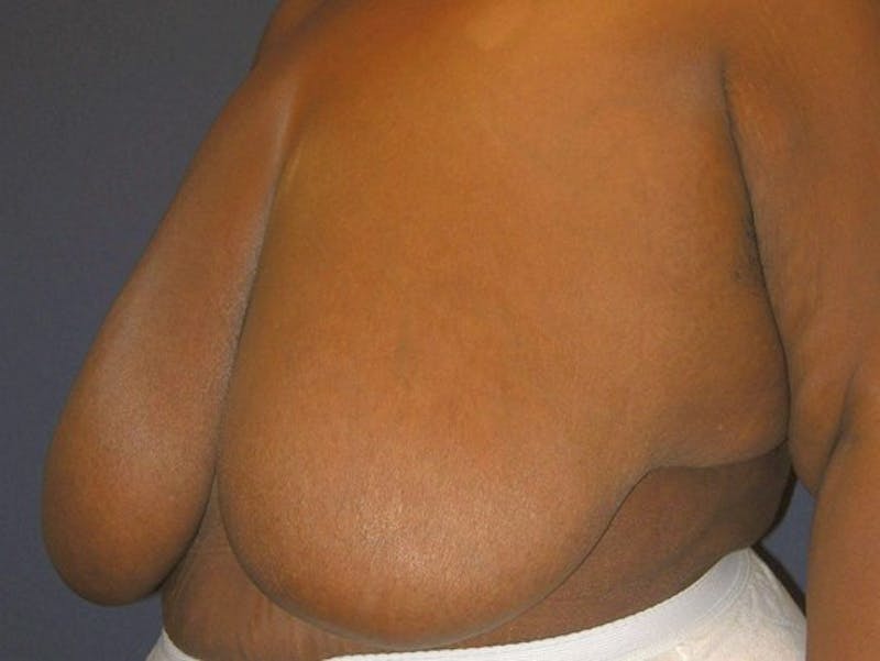 Breast Reduction by Dr. Haydon Before & After Gallery - Patient 55455198 - Image 3