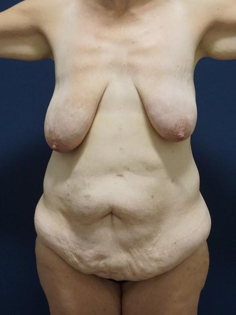 Breast Lift by Dr. Haydon Before & After Gallery - Patient 55455200 - Image 1
