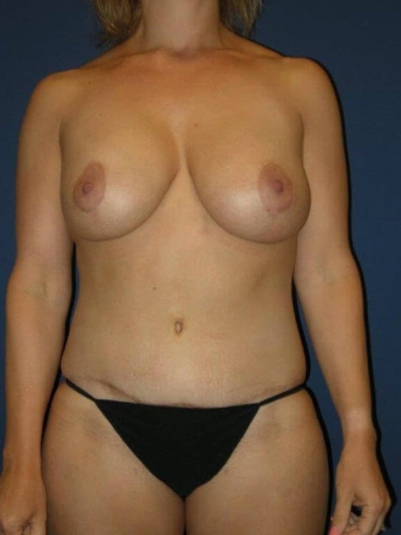 Breast Augmentation with Lift by Dr. Haydon Before & After Gallery - Patient 55455199 - Image 2