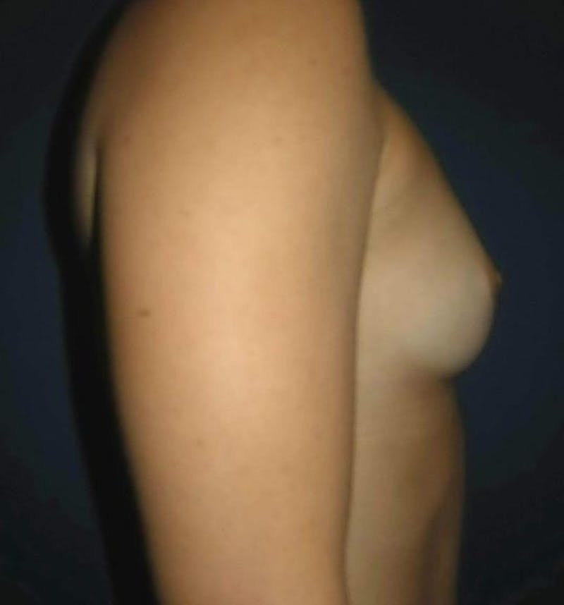 Breast Augmentation by Dr. Haydon Before & After Gallery - Patient 55455197 - Image 3