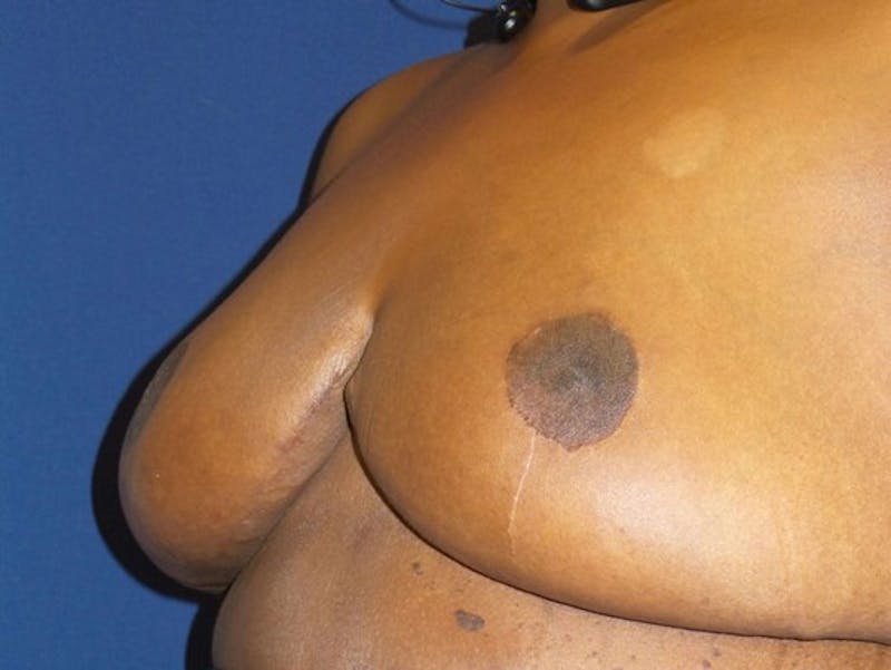 Breast Reduction by Dr. Haydon Before & After Gallery - Patient 55455198 - Image 4