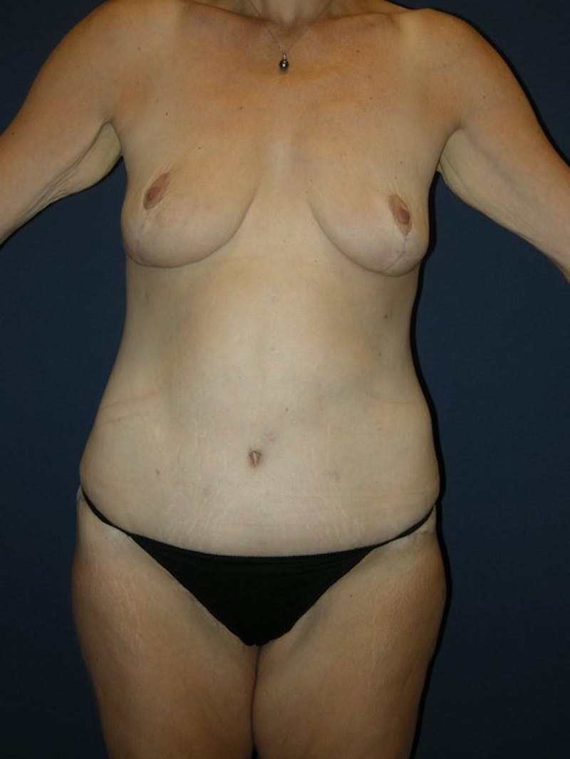 Breast Lift by Dr. Haydon Before & After Gallery - Patient 55455200 - Image 2