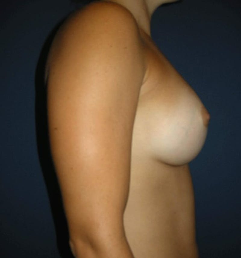 Breast Augmentation by Dr. Haydon Before & After Gallery - Patient 55455197 - Image 4