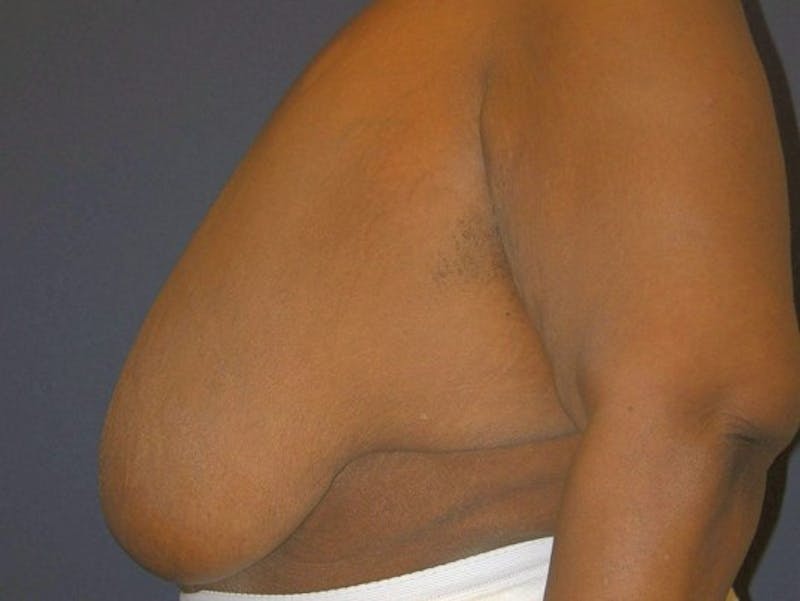 Breast Reduction by Dr. Haydon Before & After Gallery - Patient 55455198 - Image 5