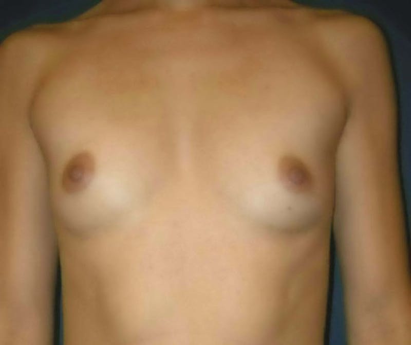 Breast Augmentation by Dr. Haydon Gallery - Patient 55455203 - Image 1
