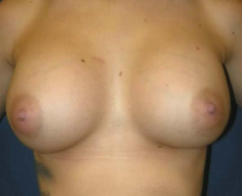 Breast Revision by Dr. Haydon Before & After Gallery - Patient 55455201 - Image 2