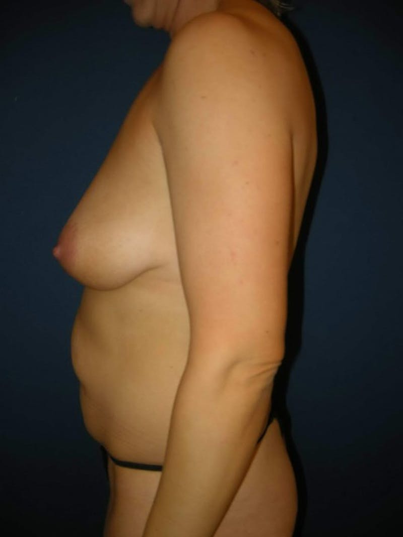Breast Augmentation with Lift by Dr. Haydon Before & After Gallery - Patient 55455199 - Image 5