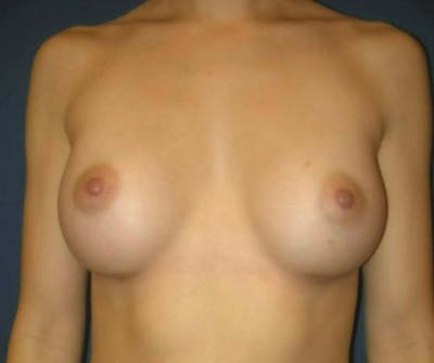 Breast Augmentation by Dr. Haydon Before & After Gallery - Patient 55455203 - Image 2