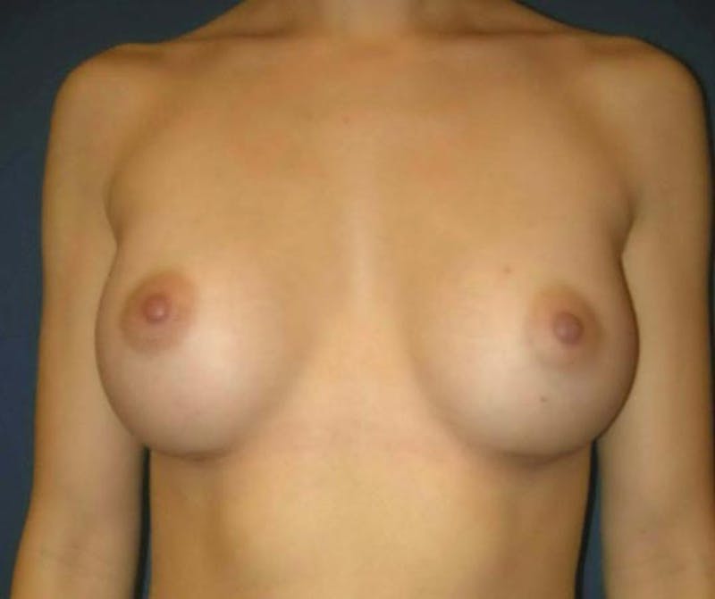 Breast Augmentation by Dr. Haydon Before & After Gallery - Patient 55455203 - Image 2