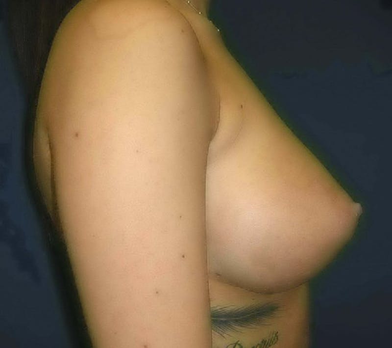 Breast Revision by Dr. Haydon Before & After Gallery - Patient 55455201 - Image 3