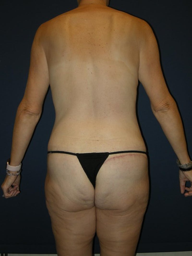 Breast Lift by Dr. Haydon Gallery - Patient 55455200 - Image 6