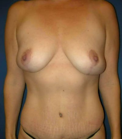 Breast Reduction by Dr. Haydon Before & After Gallery - Patient 55455206 - Image 2