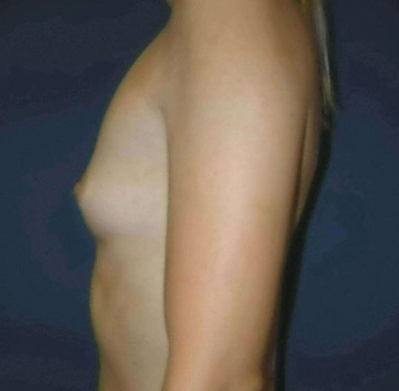 Breast Augmentation by Dr. Haydon Before & After Gallery - Patient 55455203 - Image 5
