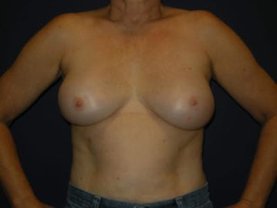 Breast Revision by Dr. Haydon Before & After Gallery - Patient 55455204 - Image 2