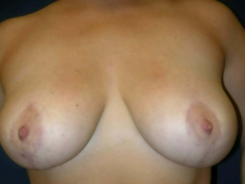 Breast Lift by Dr. Haydon Before & After Gallery - Patient 55455202 - Image 2