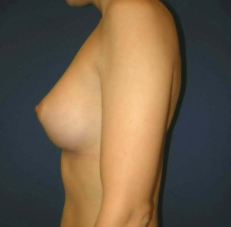 Breast Augmentation by Dr. Haydon Before & After Gallery - Patient 55455203 - Image 6