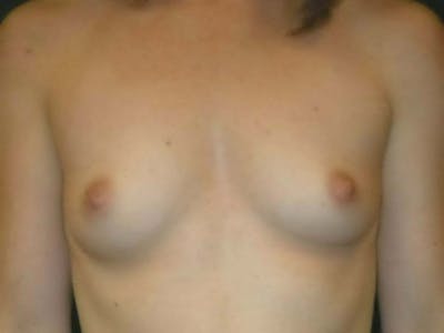 Breast Augmentation by Dr. Haydon Before & After Gallery - Patient 55455207 - Image 1