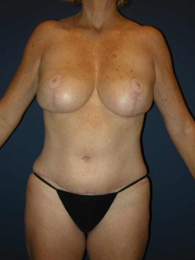Breast Lift by Dr. Haydon Before & After Gallery - Patient 55455208 - Image 2