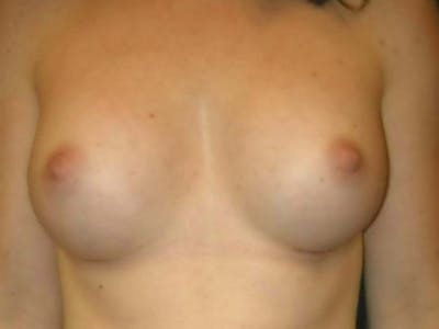 Breast Augmentation by Dr. Haydon Before & After Gallery - Patient 55455207 - Image 2
