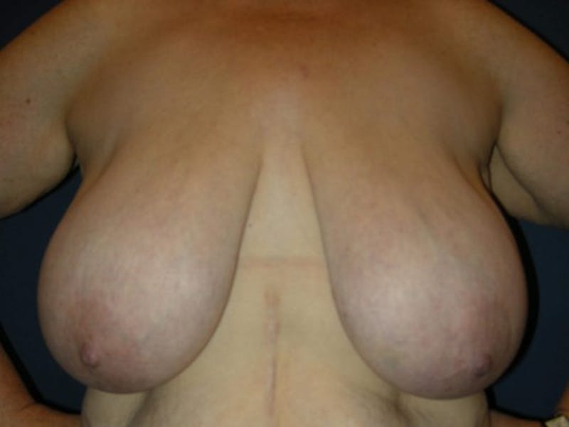 Breast Reduction by Dr. Haydon Before & After Gallery - Patient 55455209 - Image 1