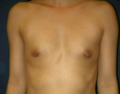 Breast Augmentation by Dr. Haydon Before & After Gallery - Patient 55455211 - Image 1