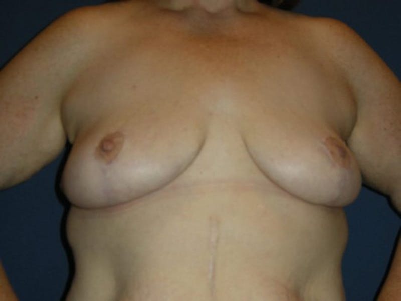 Breast Reduction by Dr. Haydon Before & After Gallery - Patient 55455209 - Image 2