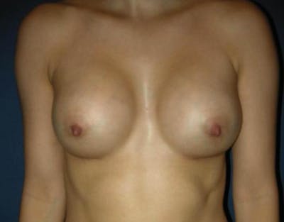 Breast Augmentation by Dr. Haydon Before & After Gallery - Patient 55455211 - Image 2