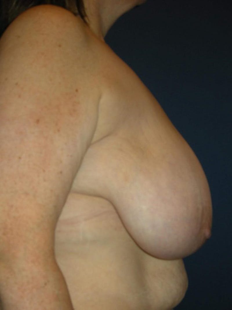 Breast Reduction by Dr. Haydon Before & After Gallery - Patient 55455209 - Image 3