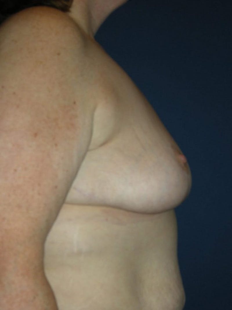 Breast Reduction by Dr. Haydon Before & After Gallery - Patient 55455209 - Image 4