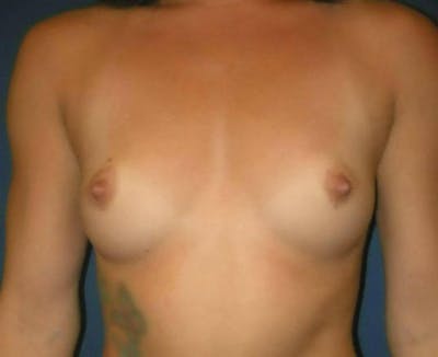 Breast Augmentation by Dr. Haydon Gallery - Patient 55455216 - Image 1
