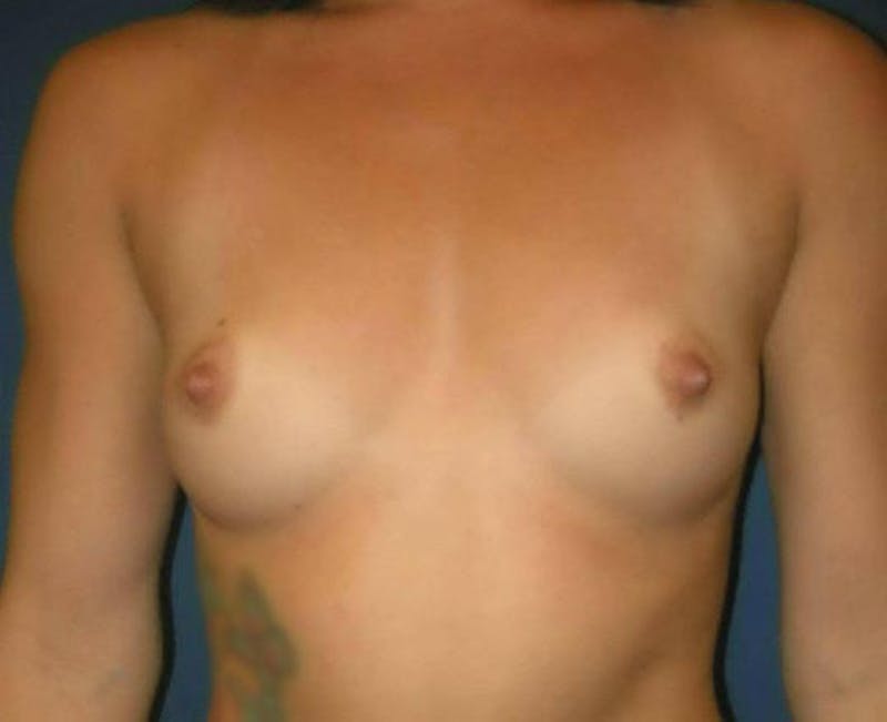 Breast Augmentation by Dr. Haydon Before & After Gallery - Patient 55455216 - Image 1