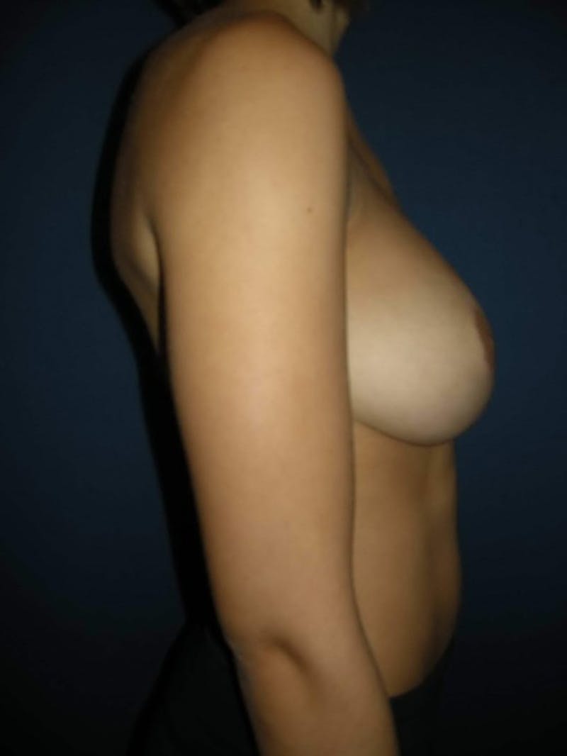 Breast Reduction by Dr. Haydon Before & After Gallery - Patient 55455213 - Image 4