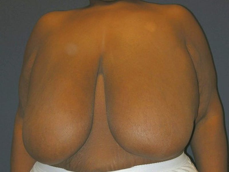 Breast Lift by Dr. Haydon Gallery - Patient 55455217 - Image 1