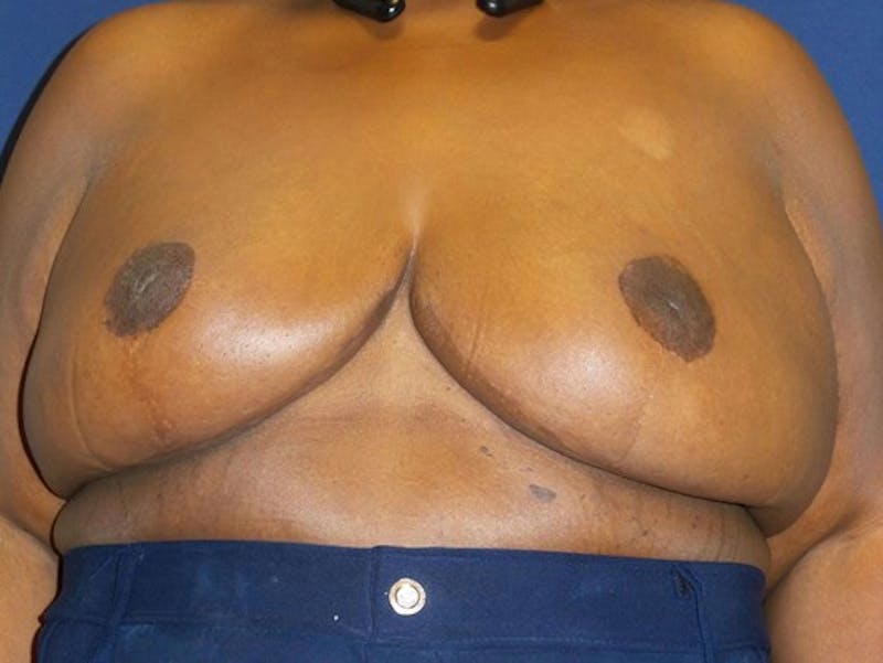Breast Lift by Dr. Haydon Before & After Gallery - Patient 55455217 - Image 2
