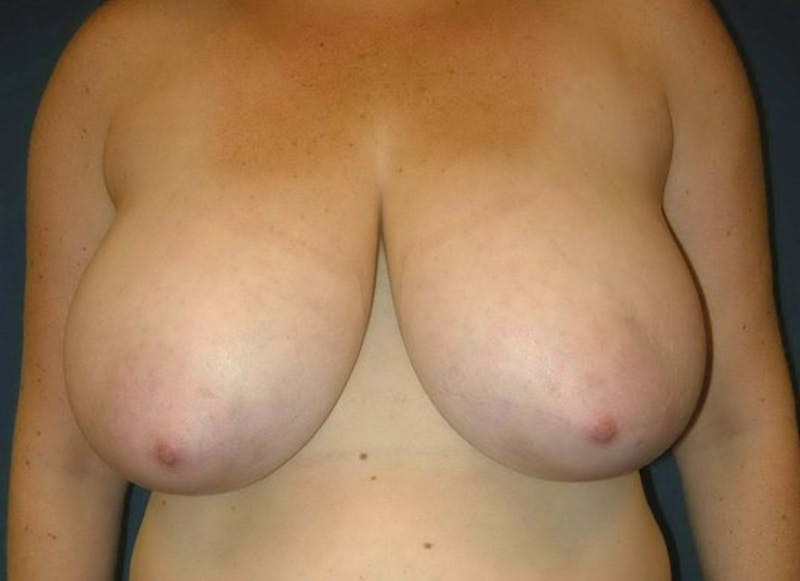 Breast Reduction by Dr. Haydon Before & After Gallery - Patient 55455215 - Image 1
