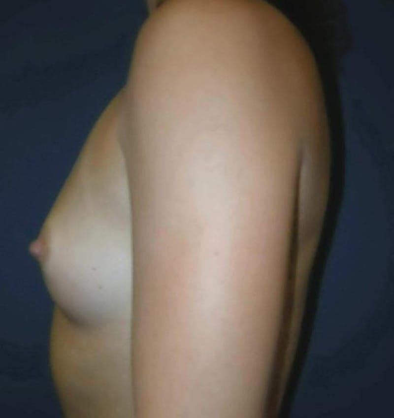 Breast Augmentation by Dr. Haydon Before & After Gallery - Patient 55455216 - Image 3