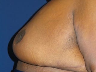 Breast Lift by Dr. Haydon Before & After Gallery - Patient 55455217 - Image 6
