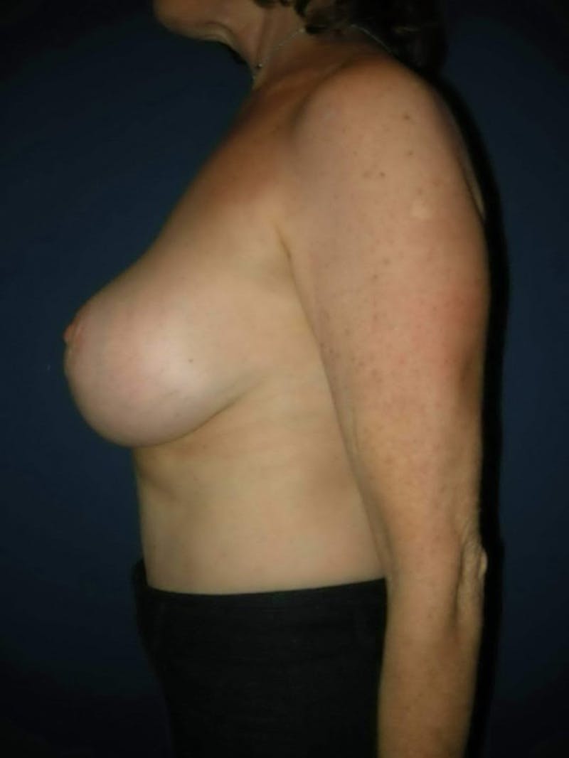Breast Revision by Dr. Haydon Before & After Gallery - Patient 55455218 - Image 3